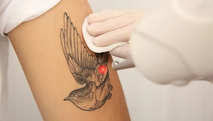 Laserowe usuwanie tatuażu w Warszawie